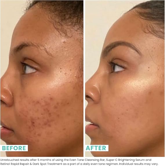 Urban Skin Rx Even Tone Cleansing Bar | 3-in-1 Daily Cleanser, Exfoliator, and Brightening Mask, Formulated with Kojic Acid, Azelaic Acid, and Niacinamide | 2.0 Oz