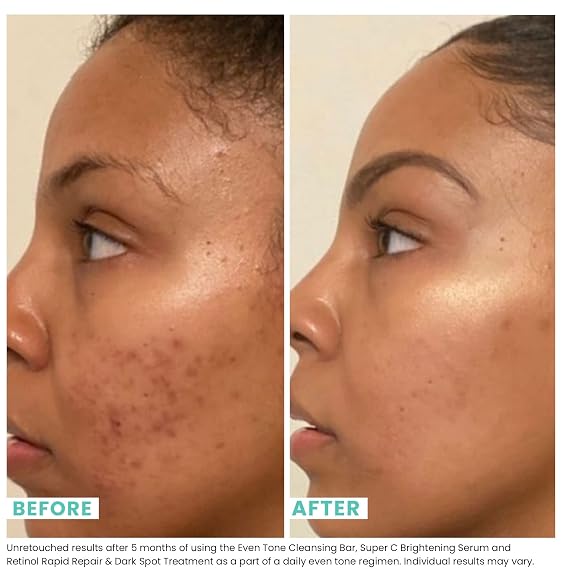 Urban Skin Rx Even Tone Cleansing Bar | 3-in-1 Multitasking Treatment Daily Cleanser, Exfoliator, Mask | Targets Uneven Skin & Improves the Appearance of Dark Spots | Includes Applicator | 2.0 Oz