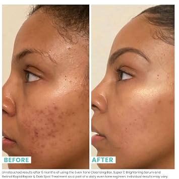 Urban Skin Rx Even Tone Cleansing Bar | 3-in-1 Multitasking Treatment Daily Cleanser, Exfoliator, Mask | Targets Uneven Skin & Improves the Appearance of Dark Spots | Includes Applicator | 2.0 Oz