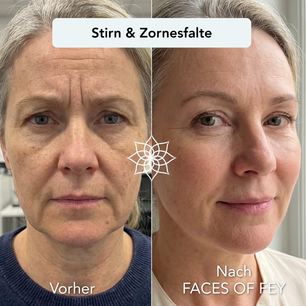 Dermaroller 0,5mm ECHTE Nadeln - Microneedling Anti Aging System 1 Monat - gegen Falten & schlaffe Haut - Zornesfalte, Strinfalten, Augenfalten, Nasolabialfalten, Mundfalten - FACES OF FEY
