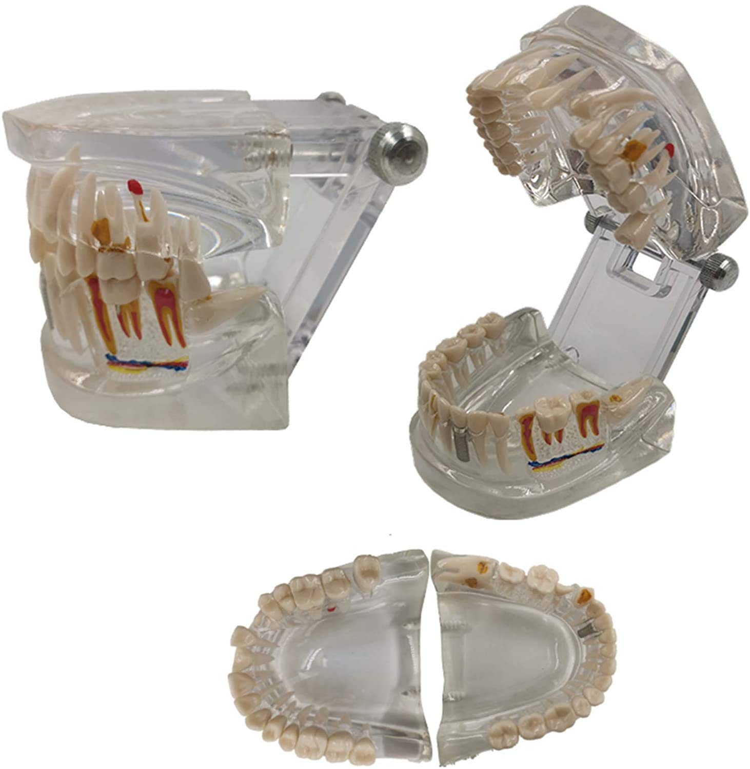 BBYYT Transparent Dental Implant Tooth Model - Permanent Teeth Model Removable Tooth Pathological Teaching Model for Teaching and Study