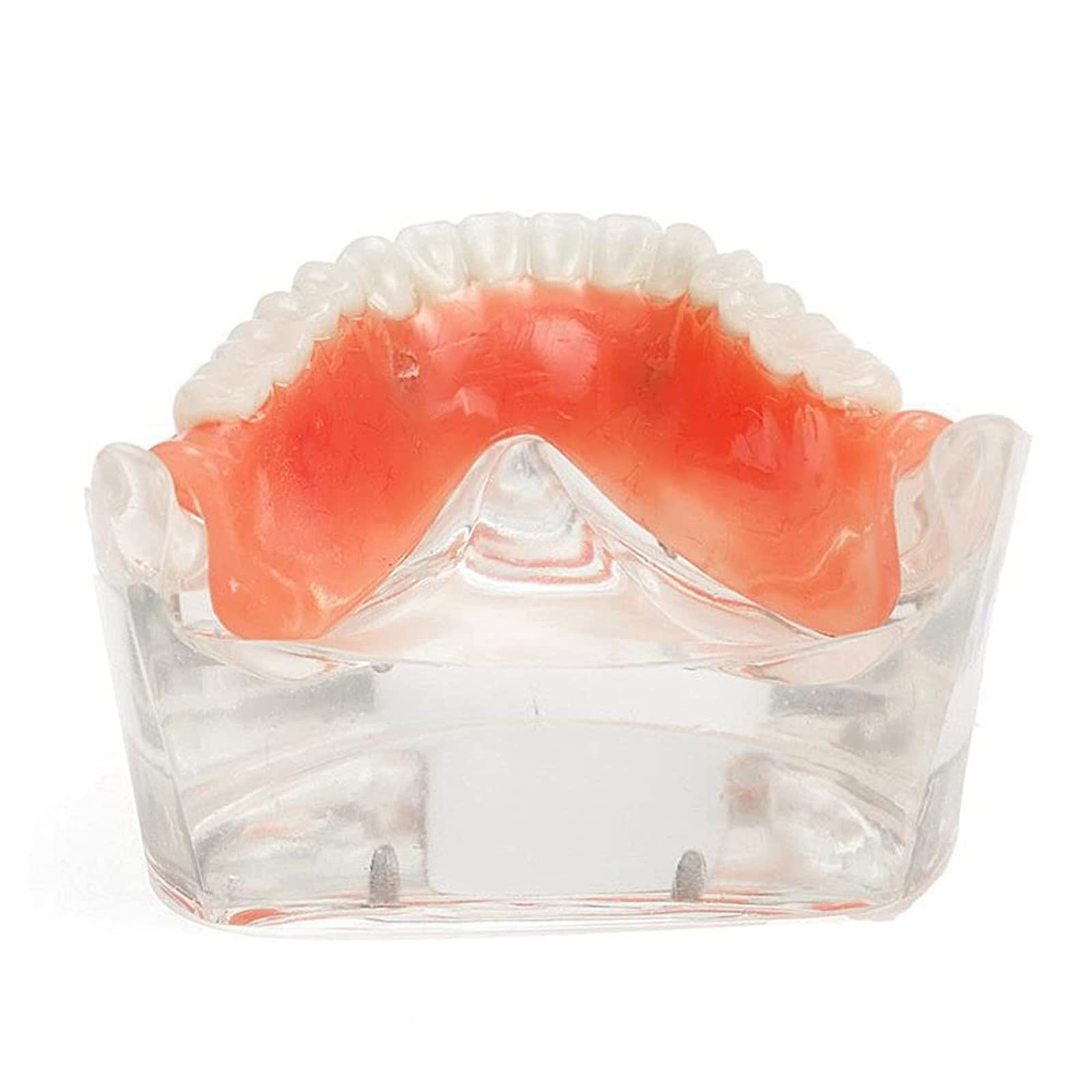 Modelo de sobredentadura Dental, modelo de dientes de enfermedad de implante, demostración de 2 implantes, para enseñar, estudiar, mostrar, comunicación con el paciente