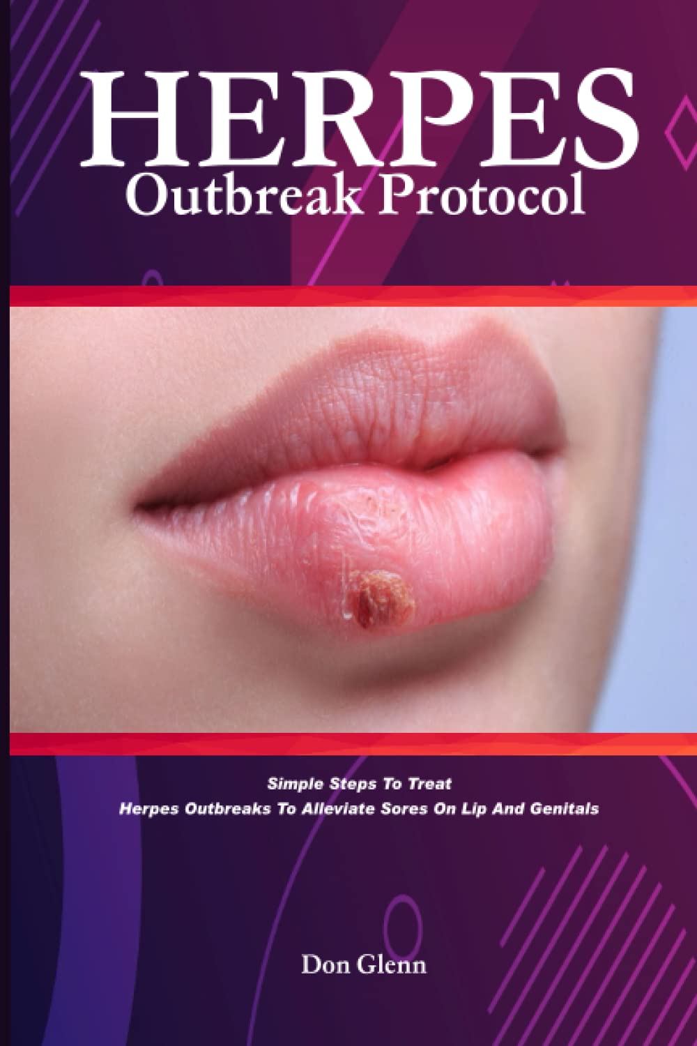 Herpes Outbreak Protocol simple steps to treat herpes outbreaks to alliviate sores on lip and genitals asap