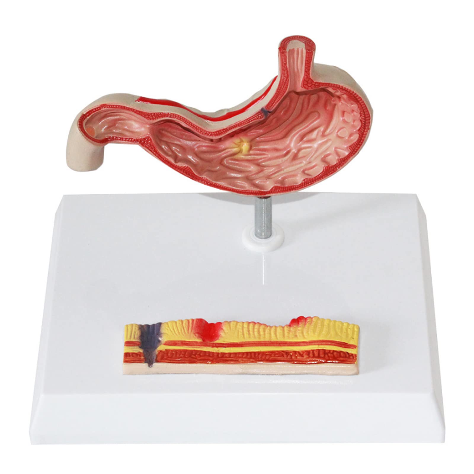 LBYLYH Gastric Ulcer Anatomy Model Stomach Disease Demonstration Model Human Stomach Model Digestive System Model for Medical Display Teaching