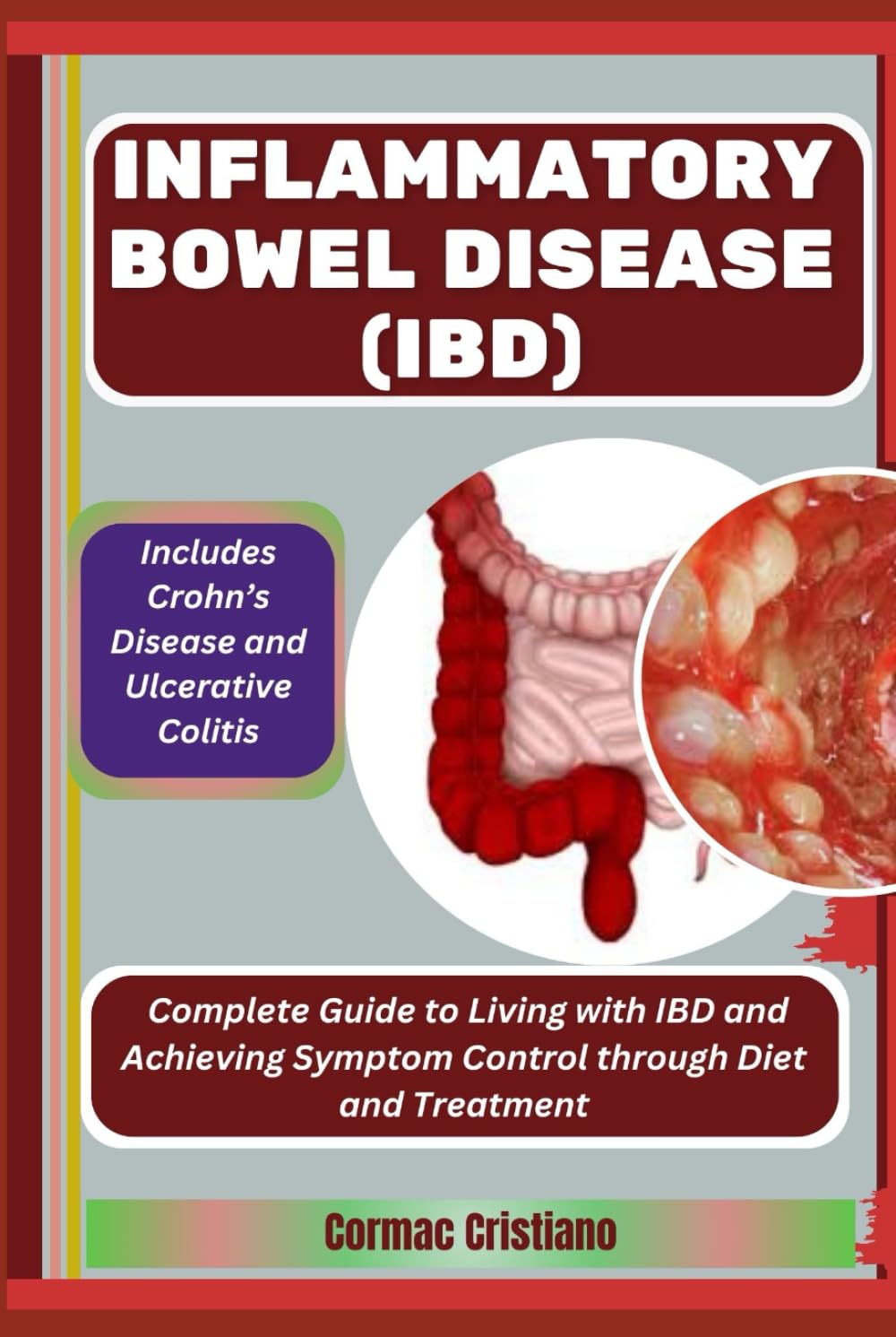 INFLAMMATORY BOWEL DISEASE (IBD): Includes Crohn’s Disease and Ulcerative Colitis: Complete Guide to Living with IBD and Achieving Symptom Control through Diet and Treatment