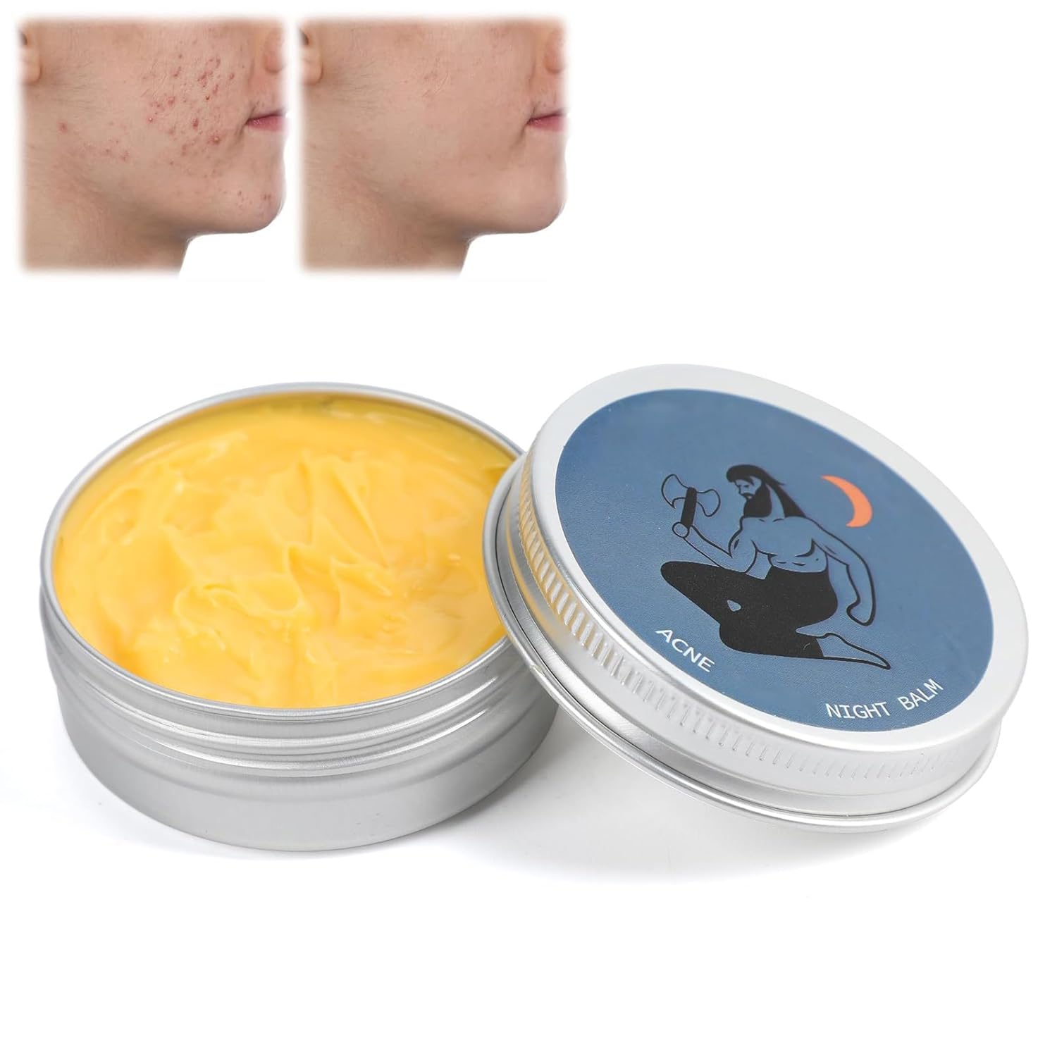 Organics Acne Balm, Acne & Redness Killer, Clearing Cream for Man,Remove Skin Care Set(1 pcs) Organics Acne Balm, Acne & Redness Killer, Clearing Cream for Man,Remove Skin Care Set(1 pcs)