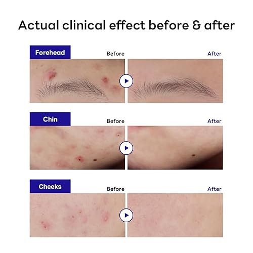 Miniatura 3 de Mediheal Derma Clear Teatree Trouble Spot Patch (44)