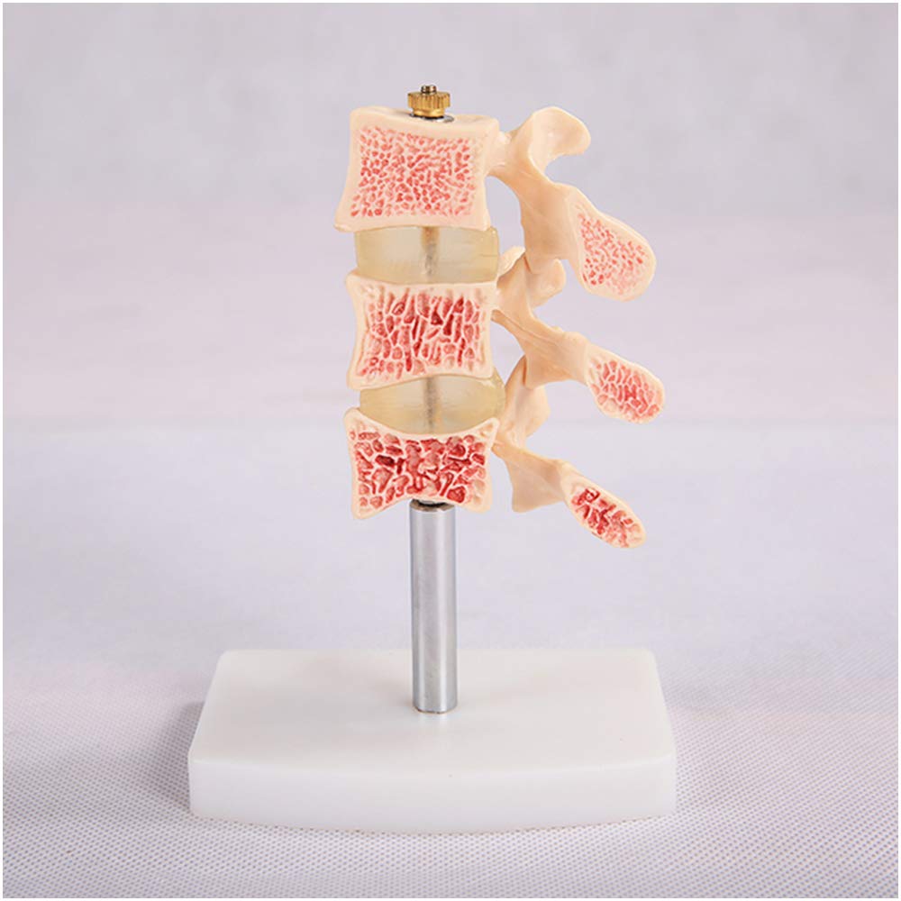 Sjdopulse A Education Model Human Osteoporosis Model - Osteoporosis Joint Model Bone Model Medical Science Human Osteoporosis Femur Bone Model For Medical Teaching Display (A)