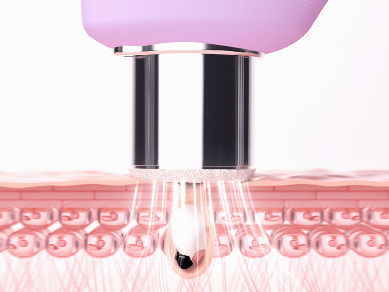 Amazon.com: FOREO Smooth & Resurface KIWI derma Microdermabrasion