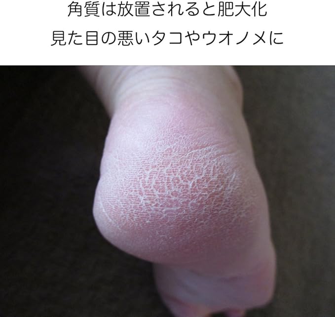 Amazon Closlation 角質除去 電動 ローラー 足裏 かかと 自宅エステ 足のお手入れ ブルー Closlation クロシレーション 魚の目削り 角質やすり 通販 Amazon Closlation 角質除去 電動 ローラー 足裏 かかと 自宅エステ 足のお手入れ ブルー Closlation クロシレーション 魚の目削り 角質やすり 通販