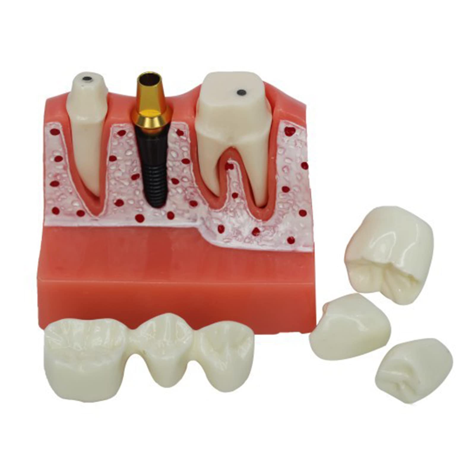 NaoSIn-Ni Tooth Model, Dental Implant Analysis Model, Removable Teeth Model Oral Dental Crown Demo Model, Dental Implant Crown Model Resin Material for Teaching Demonstration