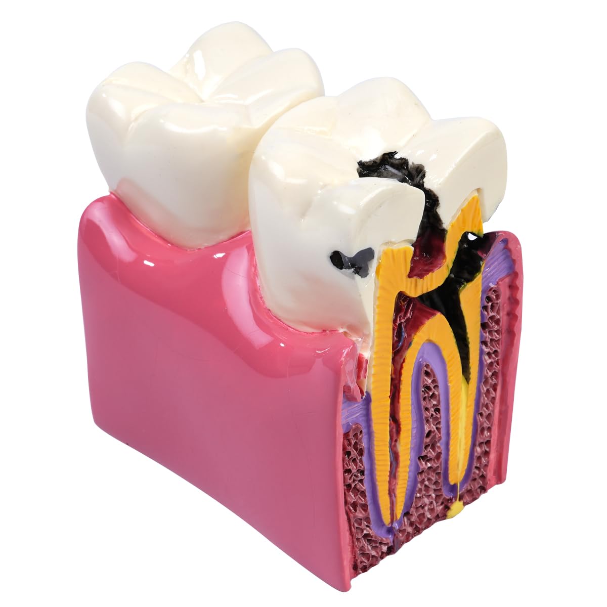 Sarini Modèle Dentaire, modèle d'étude de comparaison des Caries, modèle d'enseignement de l'anatomie Dentaire pour dentistes, adapté aux dentistes, aux Patients, aux Enseignants et aux étudiants