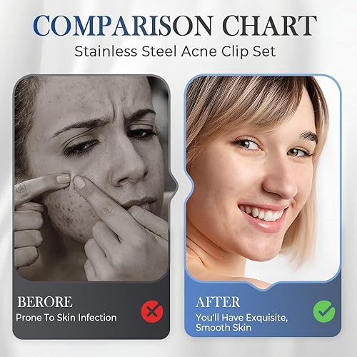 Miniatura 5 de Kit de removedor de espinillas de acero inoxidable, removedor de cabeza negra para cara y nariz, kit de herramientas para eliminar rápida y
