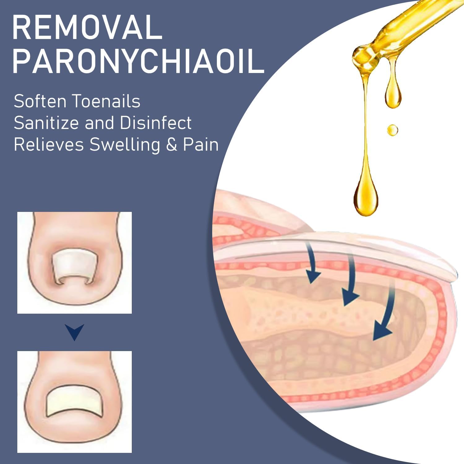 2 PCS Ingrown Toenail Care Oil, Softening Toe Nail Solution for Easy Trimming, Gentle Formula for Nail Edges - Image 3