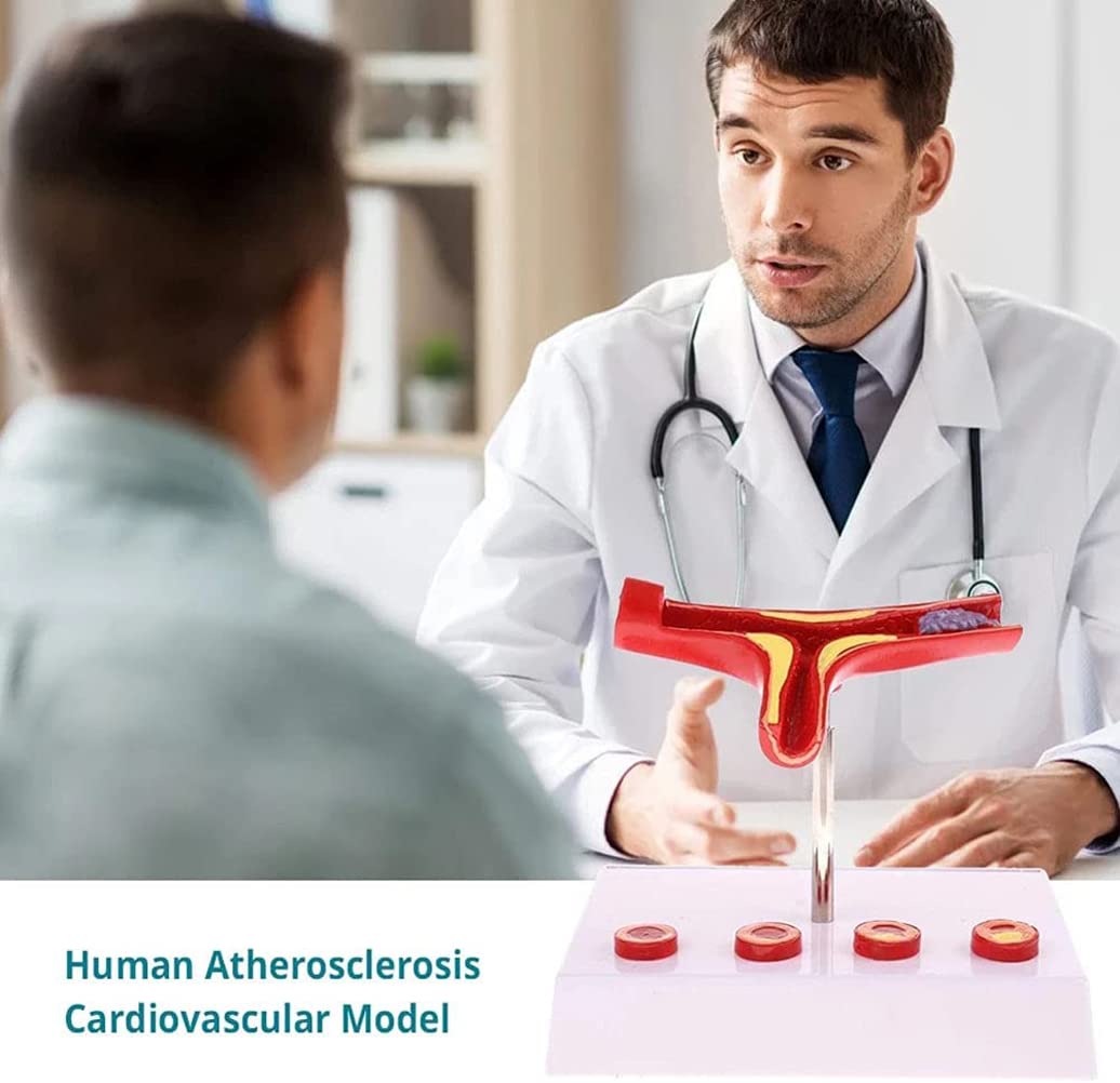Modèle de Thrombus athéroscléreux vasculaire Humain avec Base Modèle pathologique cardiovasculaire Modèle médical Matériel pédagogique