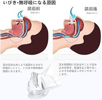 Amazon.co.jp: いびき マウスピース いびき防止グッズ 舌用マウス