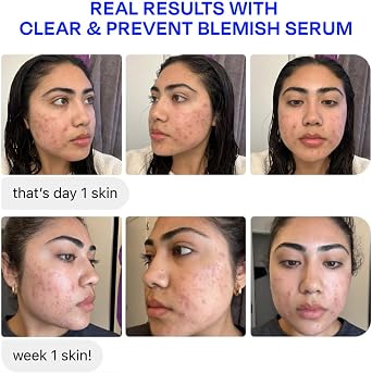 Murad Biome-Balancing Clear & Prevent Blemish Treatment Serum