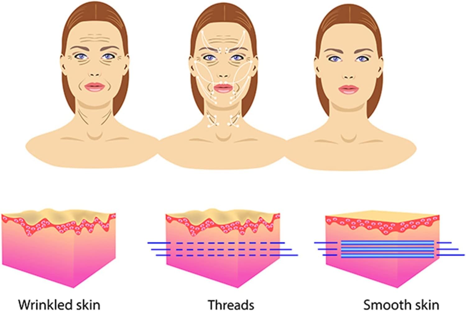 60pcs PDO Thread (リフティング糸) Lift (リフティング糸/メソン/鍼) / Ultra V-Lift/Fac