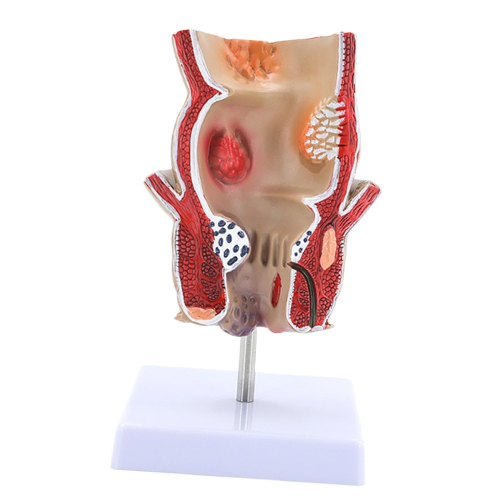 F Fityle Modelo de patología de hemorroides rectales, Material didáctico, Modelo anatómico, Herramienta de exhibición para el Aprendizaje científico.