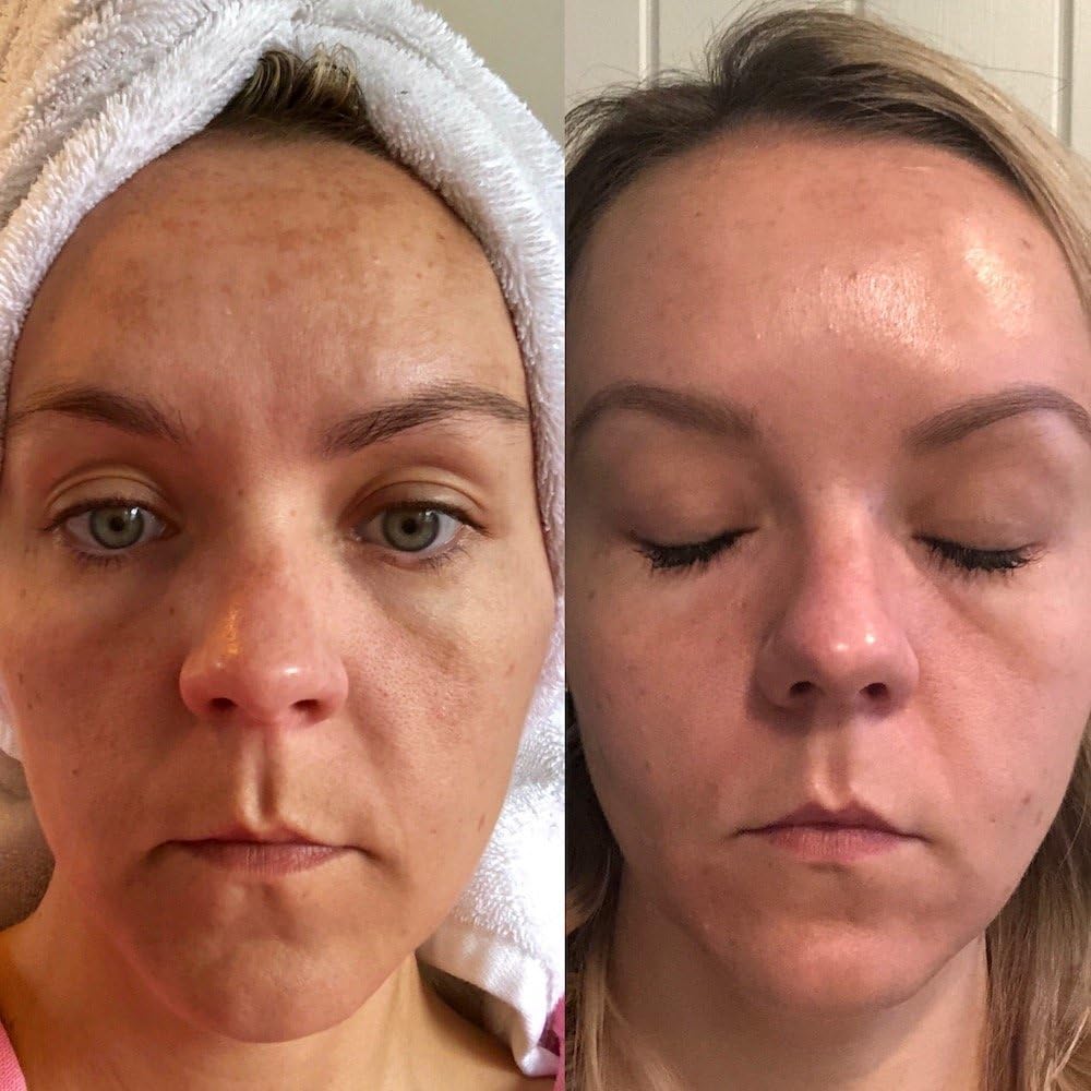TCATherapyCare Solution Acid Peel 60% (Livello 2 pH 1.9) - Esfoliante, texture e tono della pelle - peeling viso - 30 ml