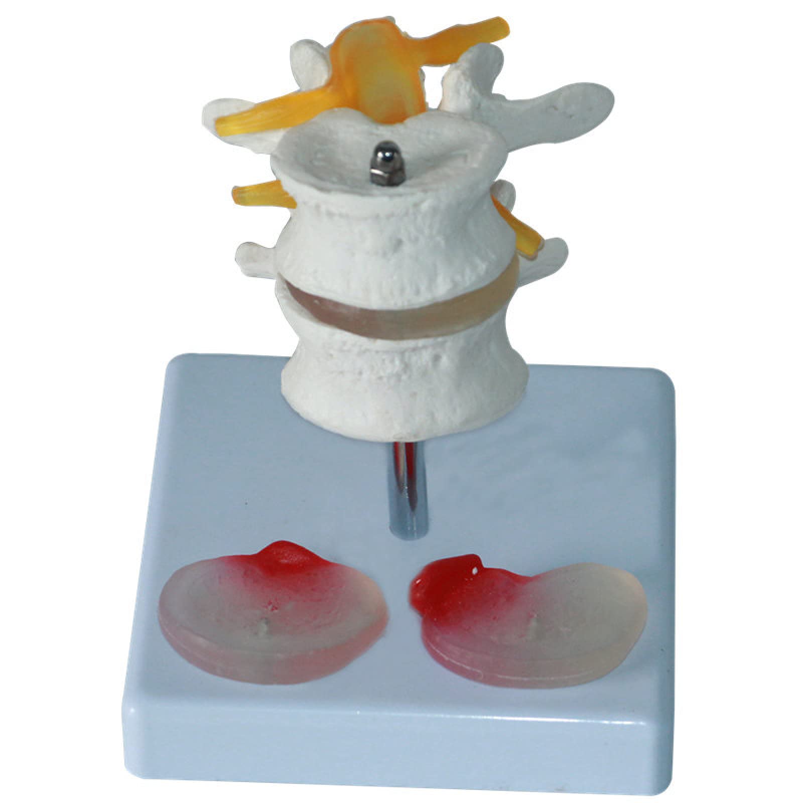 Lumbar Disc Herniation Model, Two Lumbar Vertebrae Model with Two Diseased Disc Models, Bone Anatomical Model