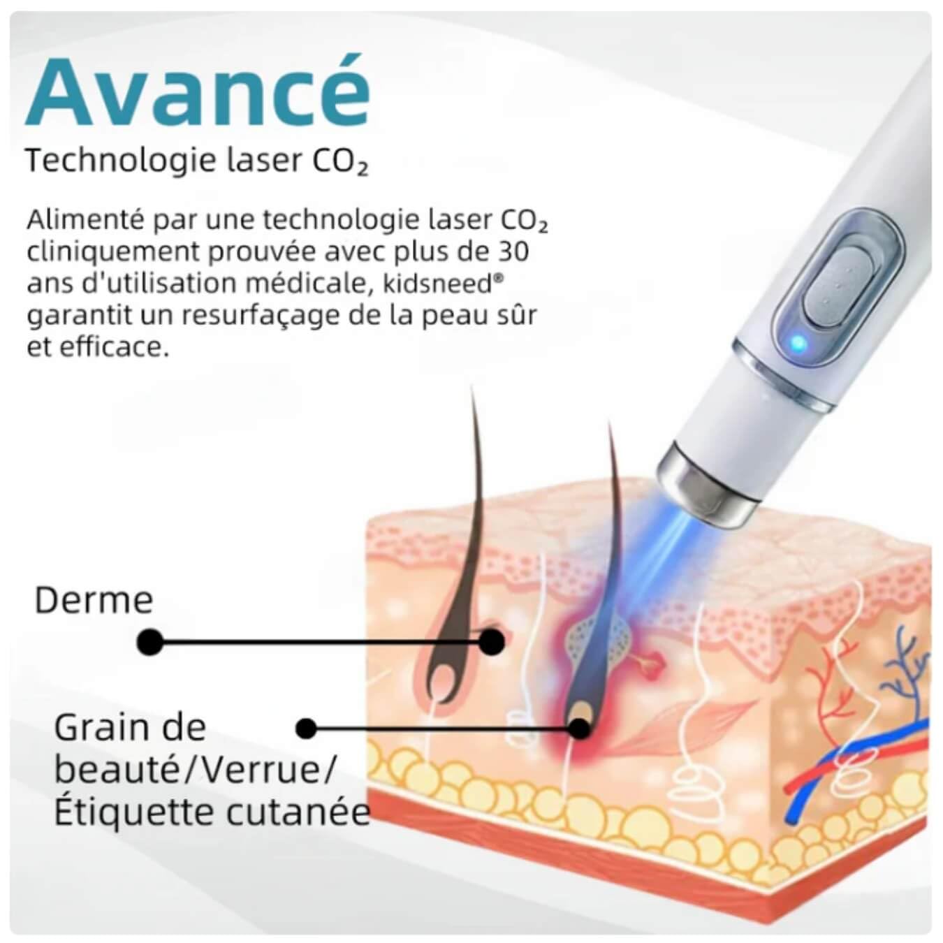 derma care Kidsneed 2.0 -Stylo Laser Non-Invasif L'élimination Efficace Des Verrues et Grains de Beauté