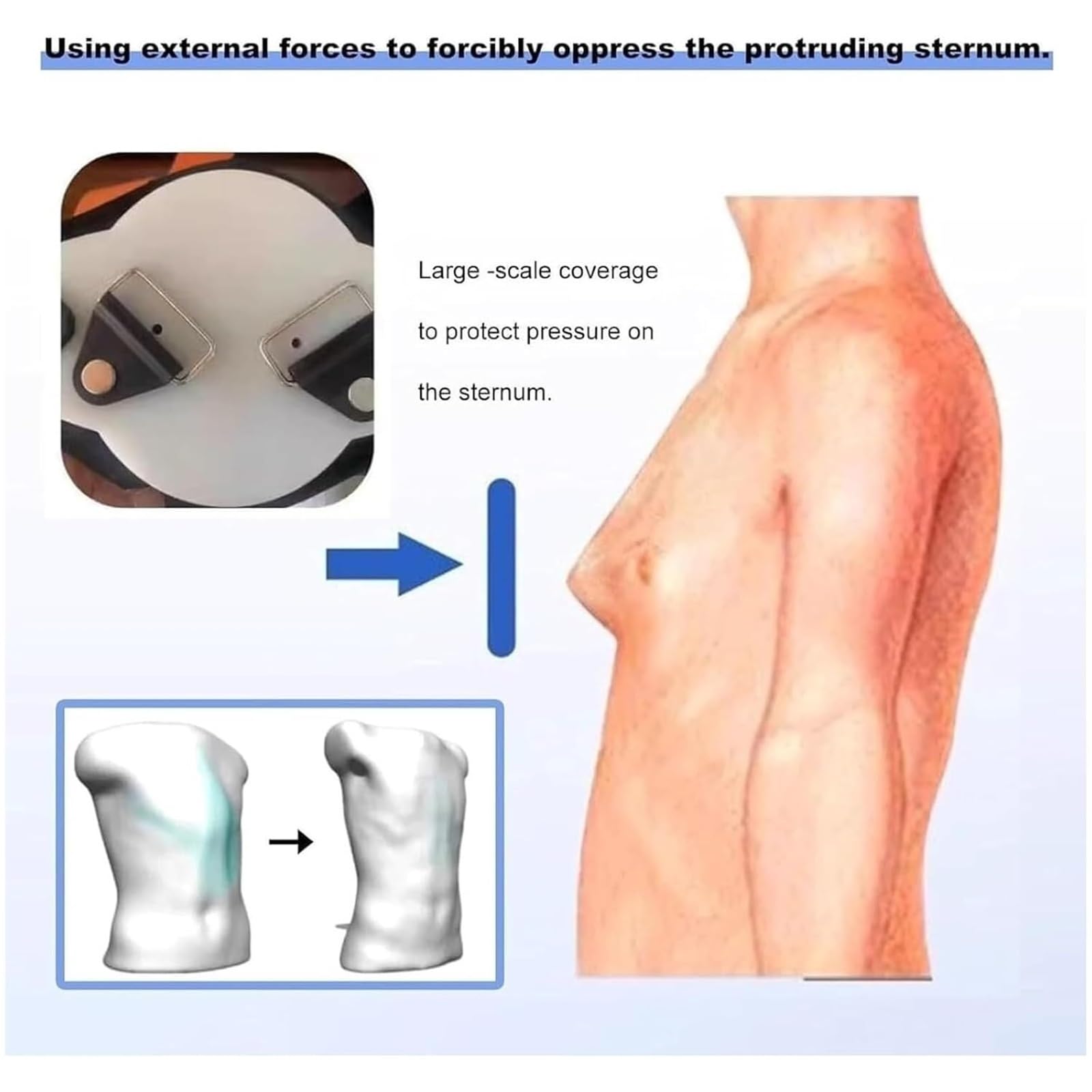 Generico Orteza pectus carinatum, przyjazna dla skóry i oddychająca, odpowiednia do rozkloszowania żeber i depresji ściany klatki piersiowej (mała)
