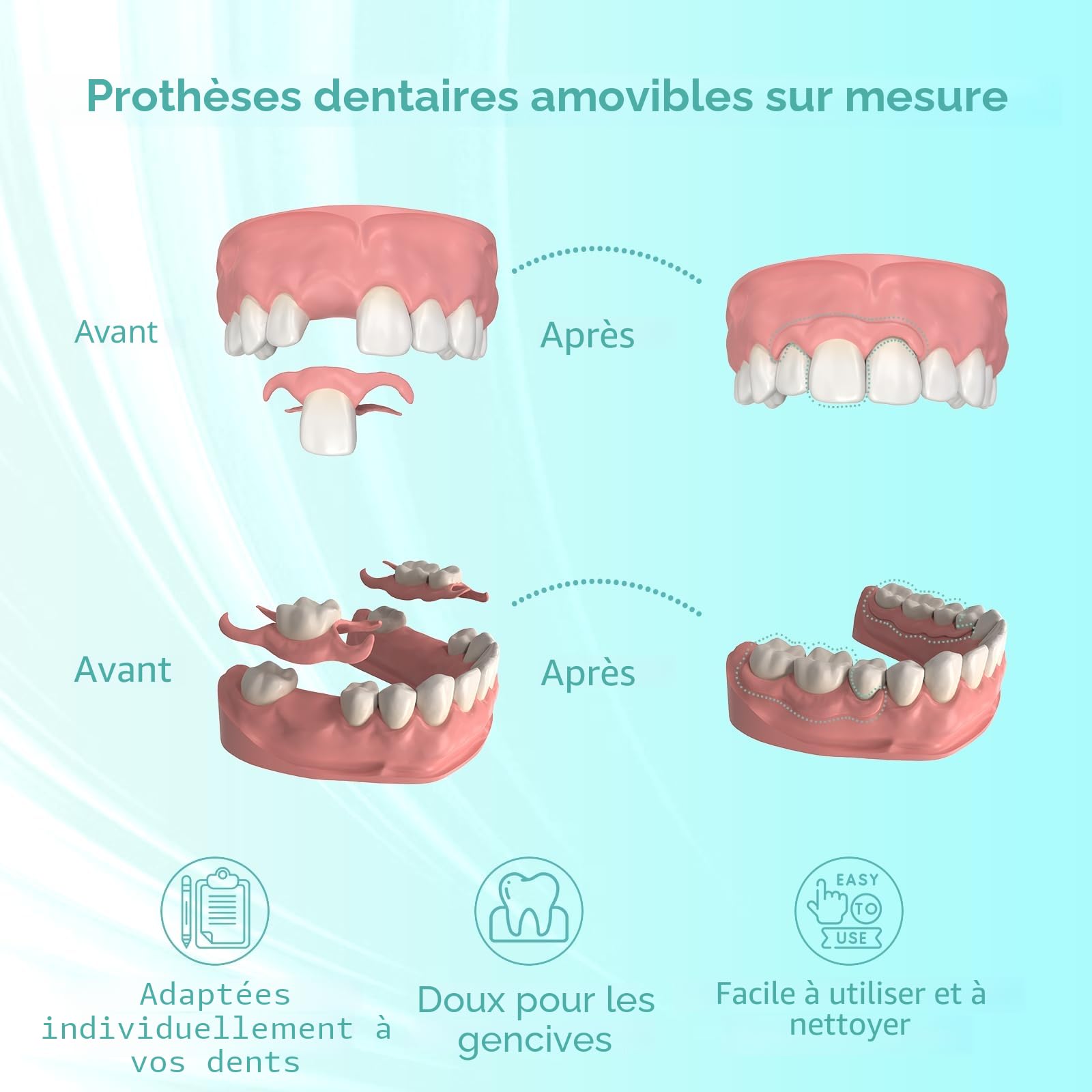 Prothèse Partielle Dentaire sur mesure - Dentier Provisoire, Prothese dentaire amovible et provisoire. Ajustement parfait et utilisation facile pour recréer votre sourire à domicile (3 dents)