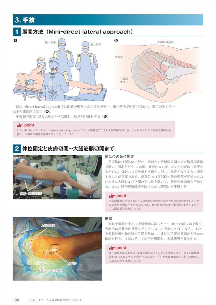 BHA・THA 人工股関節置換術パーフェクト fkip.unmul.ac.id