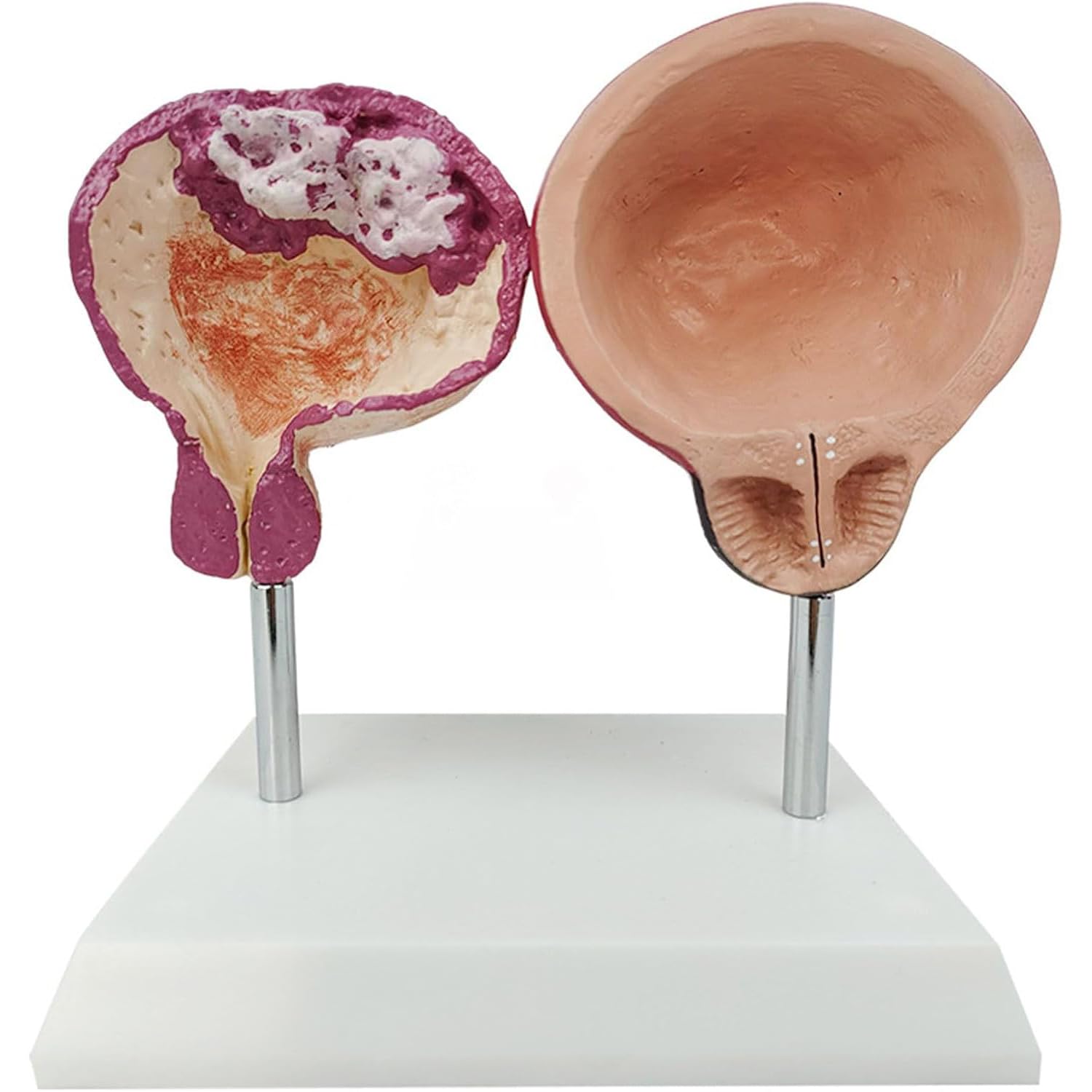 WHOOLEFUN Healthy VS Pathological Bladder Model, Prostate Pathological Anatomy Model, Smoking Bladder Demonstration, Male Urinary Reproductive System, for Medical Teaching