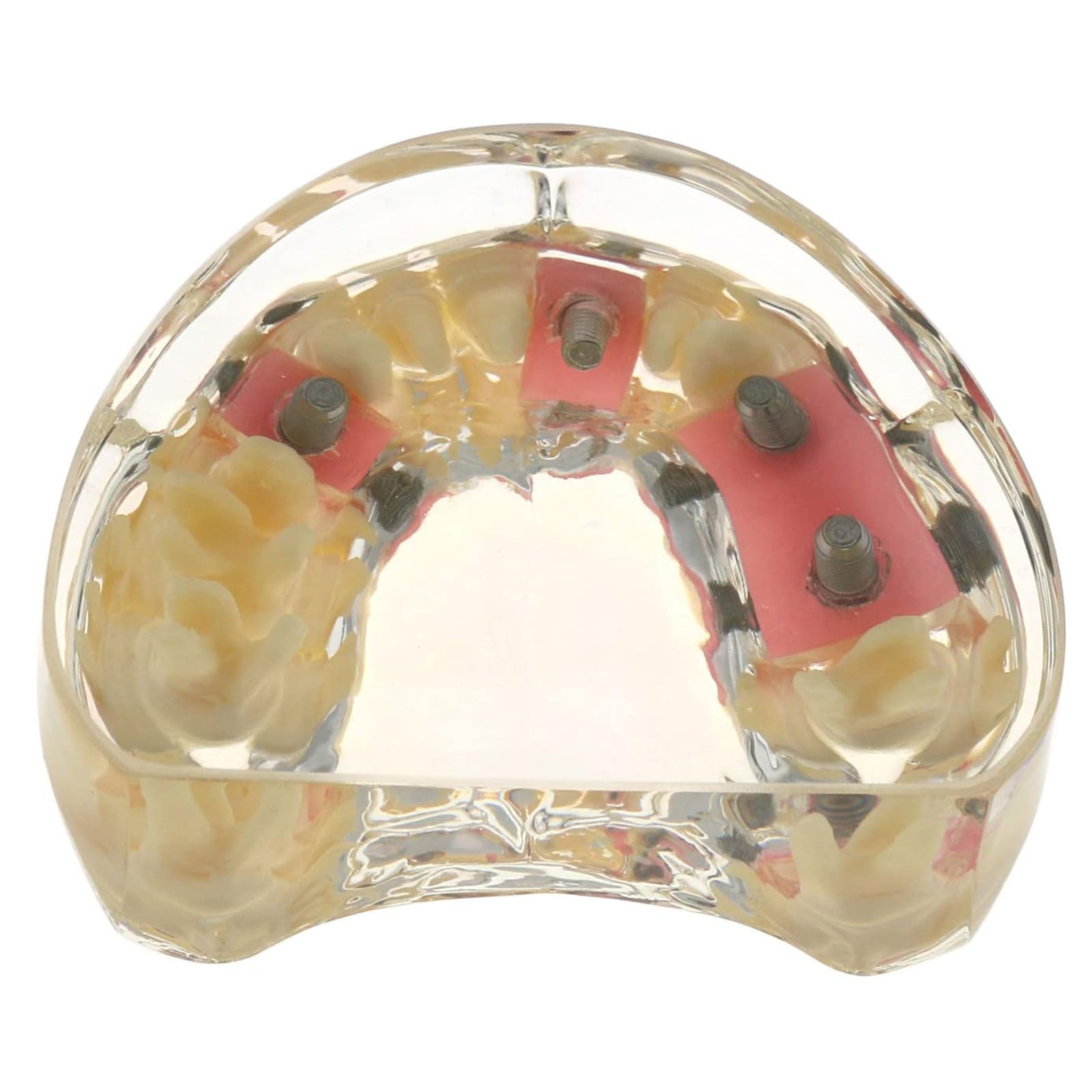 Impianto Dentale Typodont Modello per Restauro e Trattamento Dimostrazione, Strumento Educativo per Studio e Insegnamento in Odontoiatria