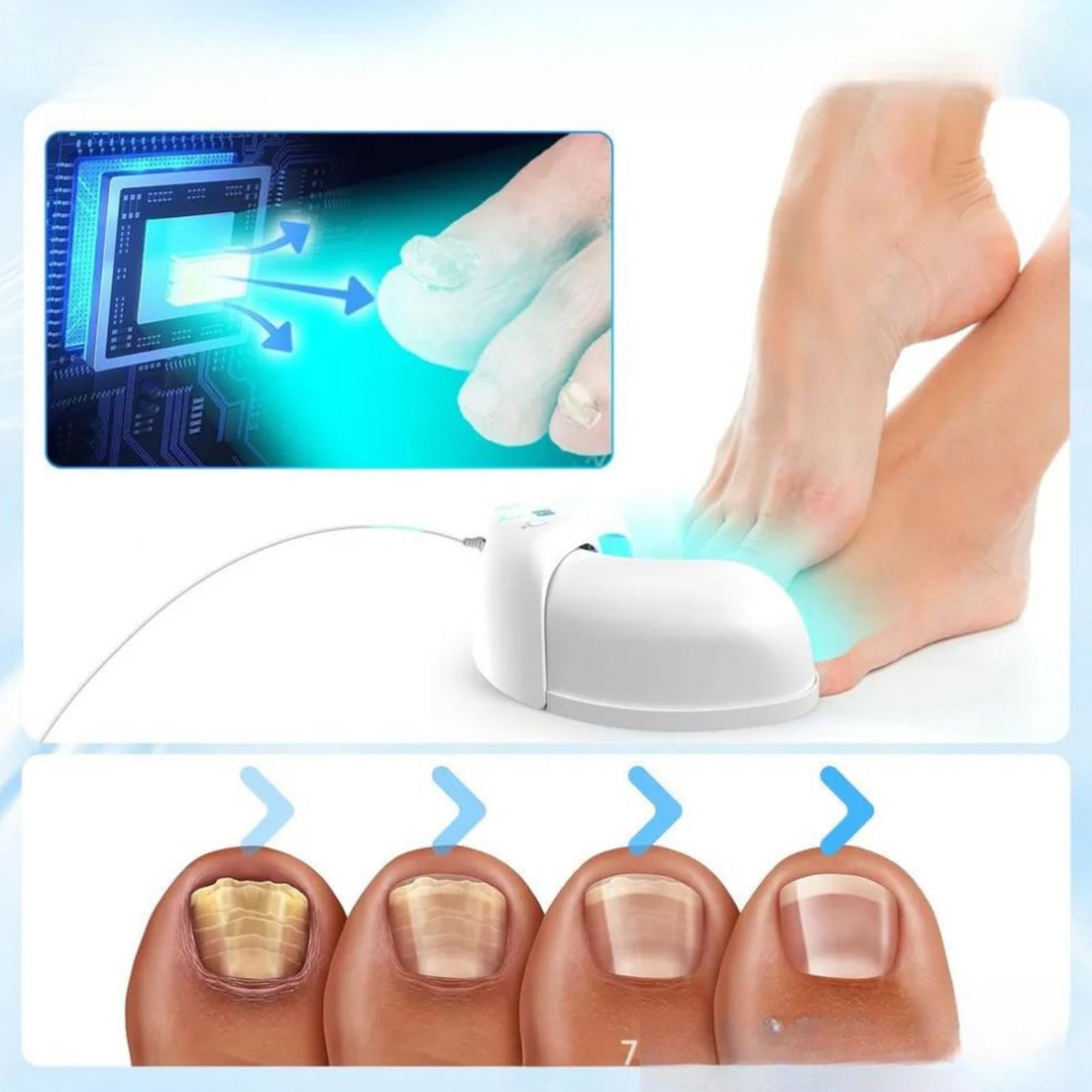 Appareil laser contre les champignons des ongles - Pour plusieurs ongles des mains et des orteils - Pour ongles endommagés et décolorés
