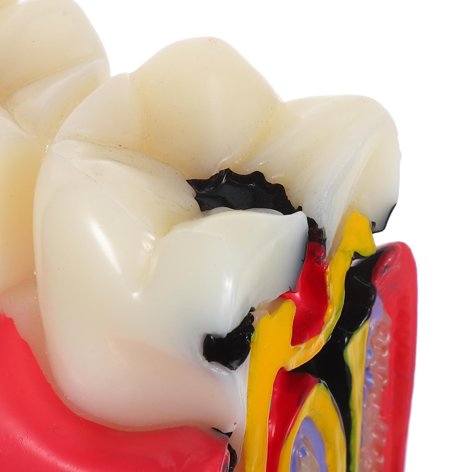 Alipis Modèle D'enseignement Comparatif de Carie Dentaire en Résine pour Dentiste Simulation Précise, Application Polyvalente pour L'éducation à Domicile et Scolaire