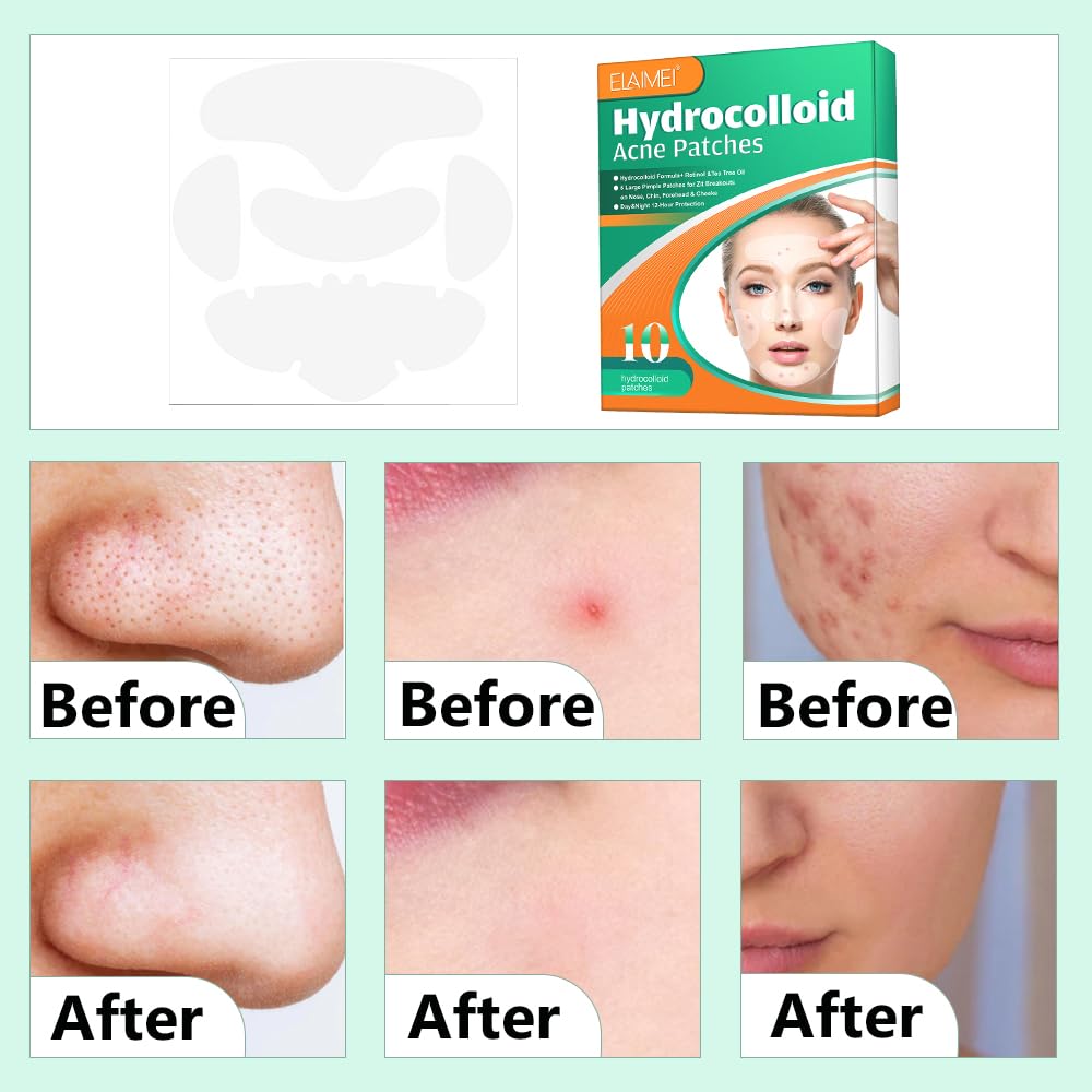 1 Box Acne Patch,Large Pimple Patch Spot Control Cover, Acne Patch for Covering Large Breakouts, Spot Patch, Pimple Stickers for Body, Cheek, Forehead, Chin Effectively Calms & Relieves Acne - Image 4