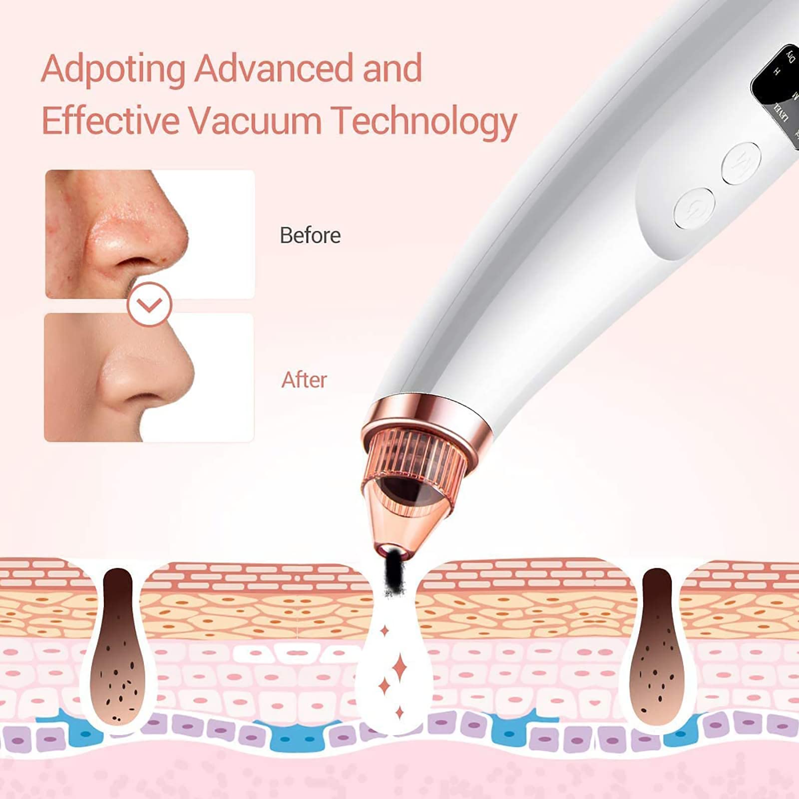 Herramienta extractora de puntos blancos para acné y comedones, extractor de espinillas de limpieza facial, limpiador de poros faciales, herramienta de succión de puntos negros, kit de extractor de
