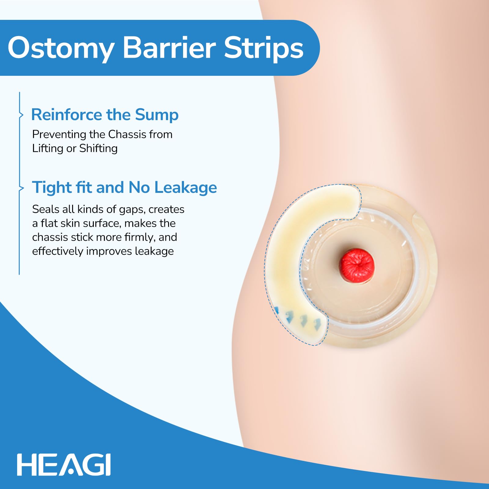 20 Tiras EláSticas de Barrera para Ostomía, Tiras de Barrera CutáNea Hidrocoloide de Grado MéDico, Cinta Adhesiva Impermeable y Respetuosa Con La Piel para Bolsas de Estoma de Colostomía