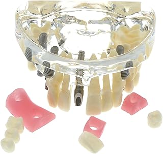 Dental Typodont Teeth Model Demonstrates Implant 4 Implants Abutment Soft Gingivae Crowns Bridge Overdenture Superior Upper Restoration Studying Teaching Demo M2005
