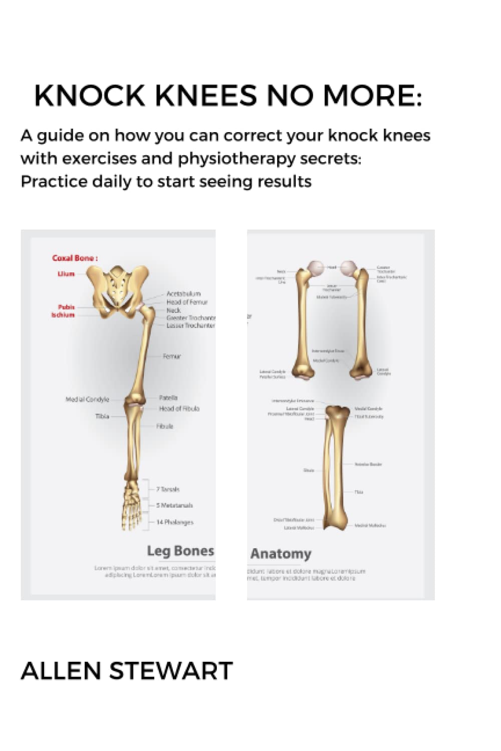 Knock Knees No More: A guide on how you can correct your knock knees with exercises and physiotherapy secrets: practice daily to start seeing results:
