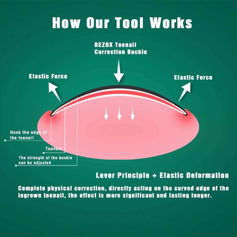 BEZOX 2Pcs Ingrown Toenail Tools, Ingrown Toenail Correction Buckle and Toenail Lifter for