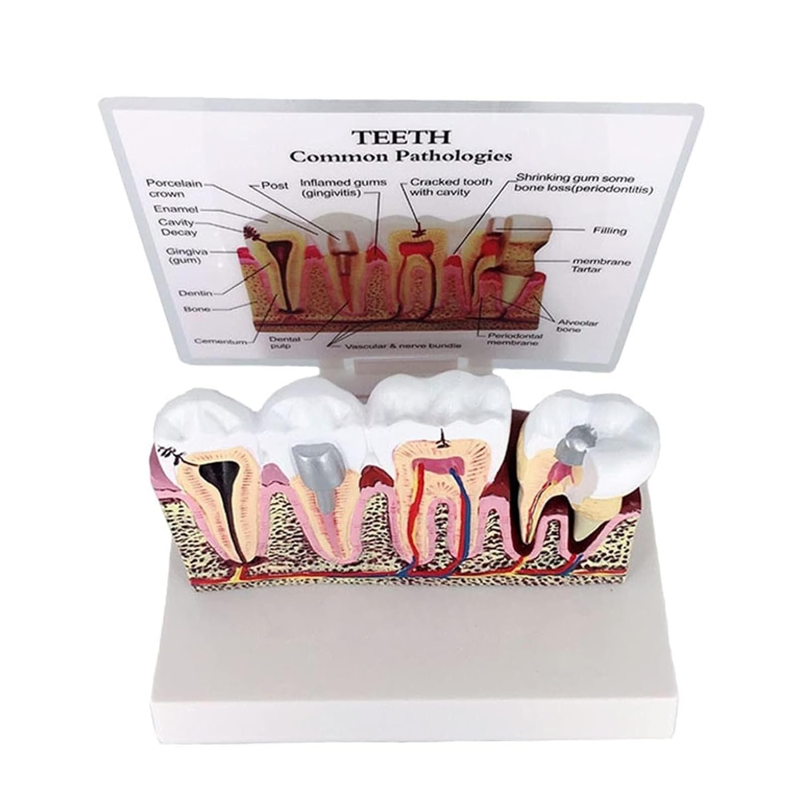 Modèle de dents d'éducation en anatomie dentaire – Modèle de section transversale des dents avec gencives dentaires amovibles pour affichage de pathologie, parfait pour les étudiants et les