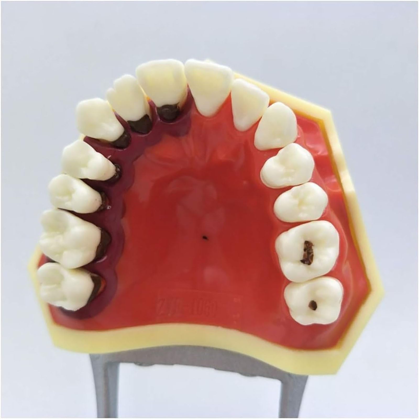 Parodontalpathologisches Zahnmodell mit abnehmbarer Gingiva, Demonstrationsmodell for die zahnmedizinische Patientenaufklärung for Zahnärzte und mündliche Unterrichtskommunikation