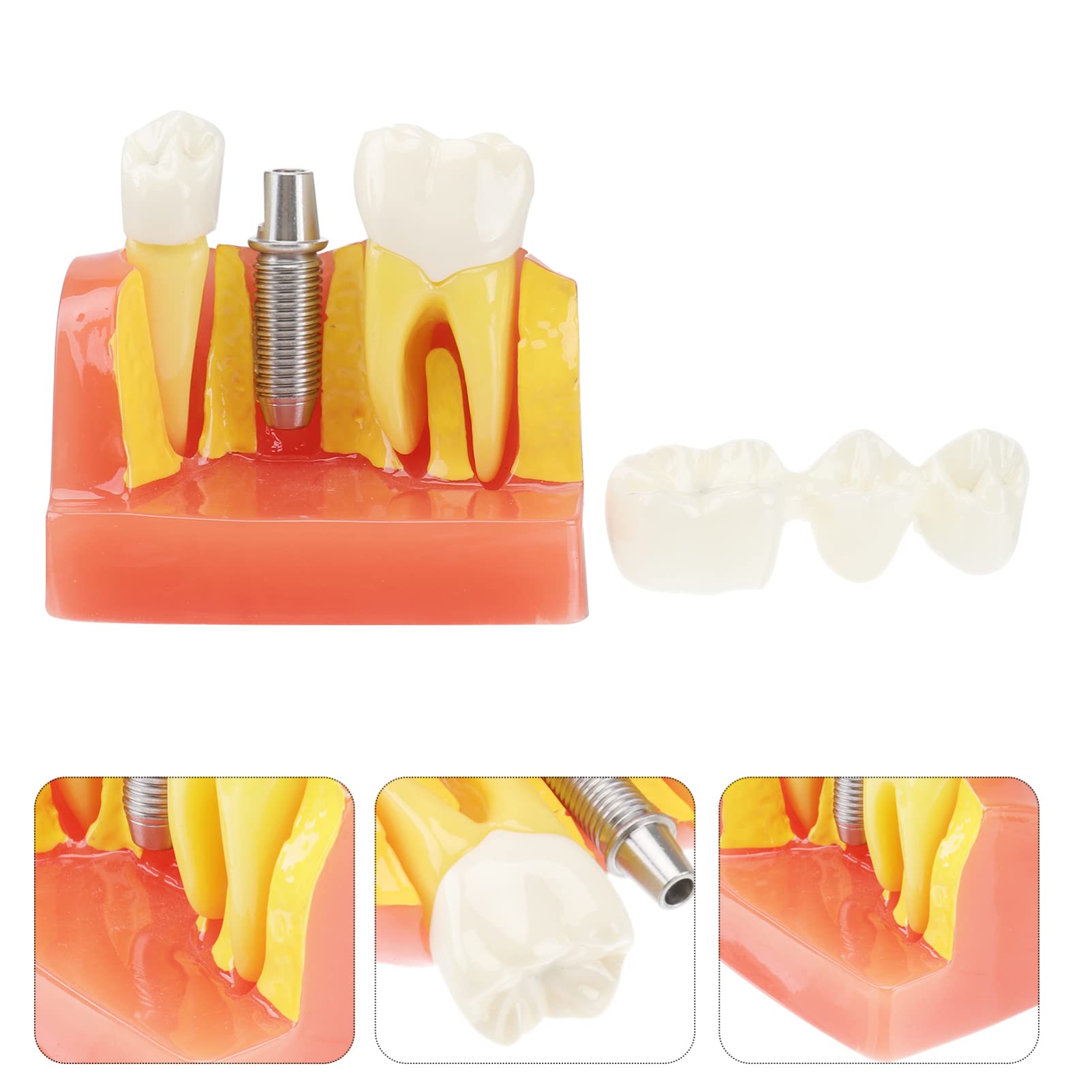OUNONA 1pezzi Modello di Denti Didattico Rimovibile per Strumento Educativo per Lezioni di Odontoiatria Modello di Studio con Denti e Protesi
