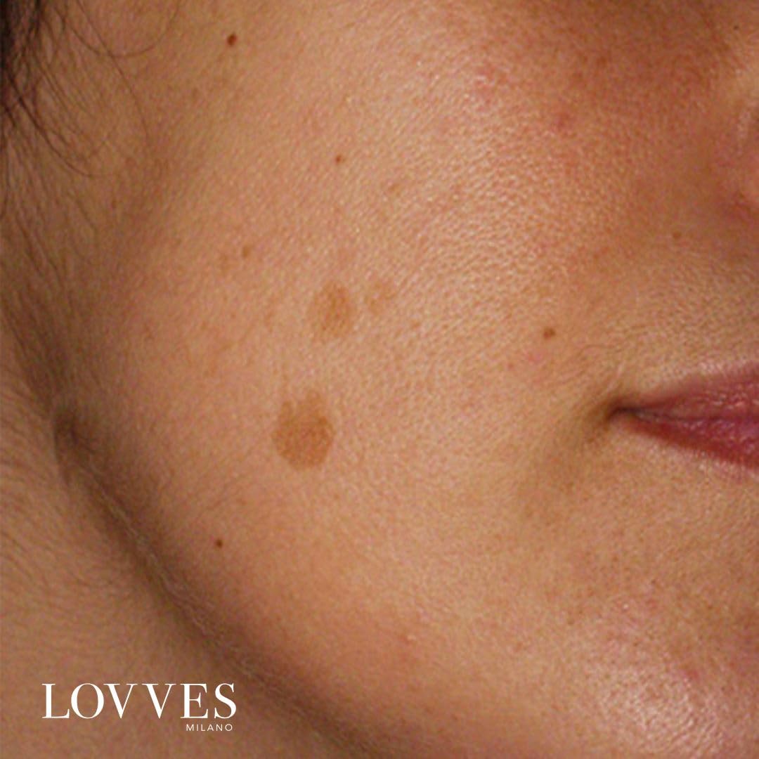 LOVVES Siero Viso Anti macchie, Schiarente, Alta Cosmesi Naturale, Depigmentante, Riduce le Ipercromie della Pelle, Previene la Formazione di macchie scure, Pelle più Uniforme e Luminosa, Flacone 30ml