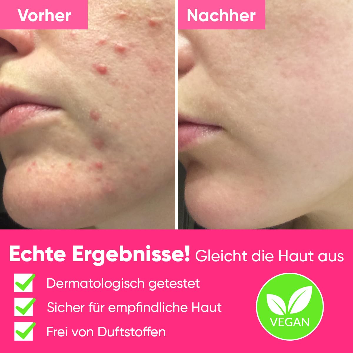 Ame Pure Peels So Good Fruchtsäure-Peeling – 120 ml Sanftes Gesichtspeeling Gel – AHA/BHA Peeling für das Gesicht - Enthüllt reine strahlende Haut - Geeignet für empfindliche Haut!