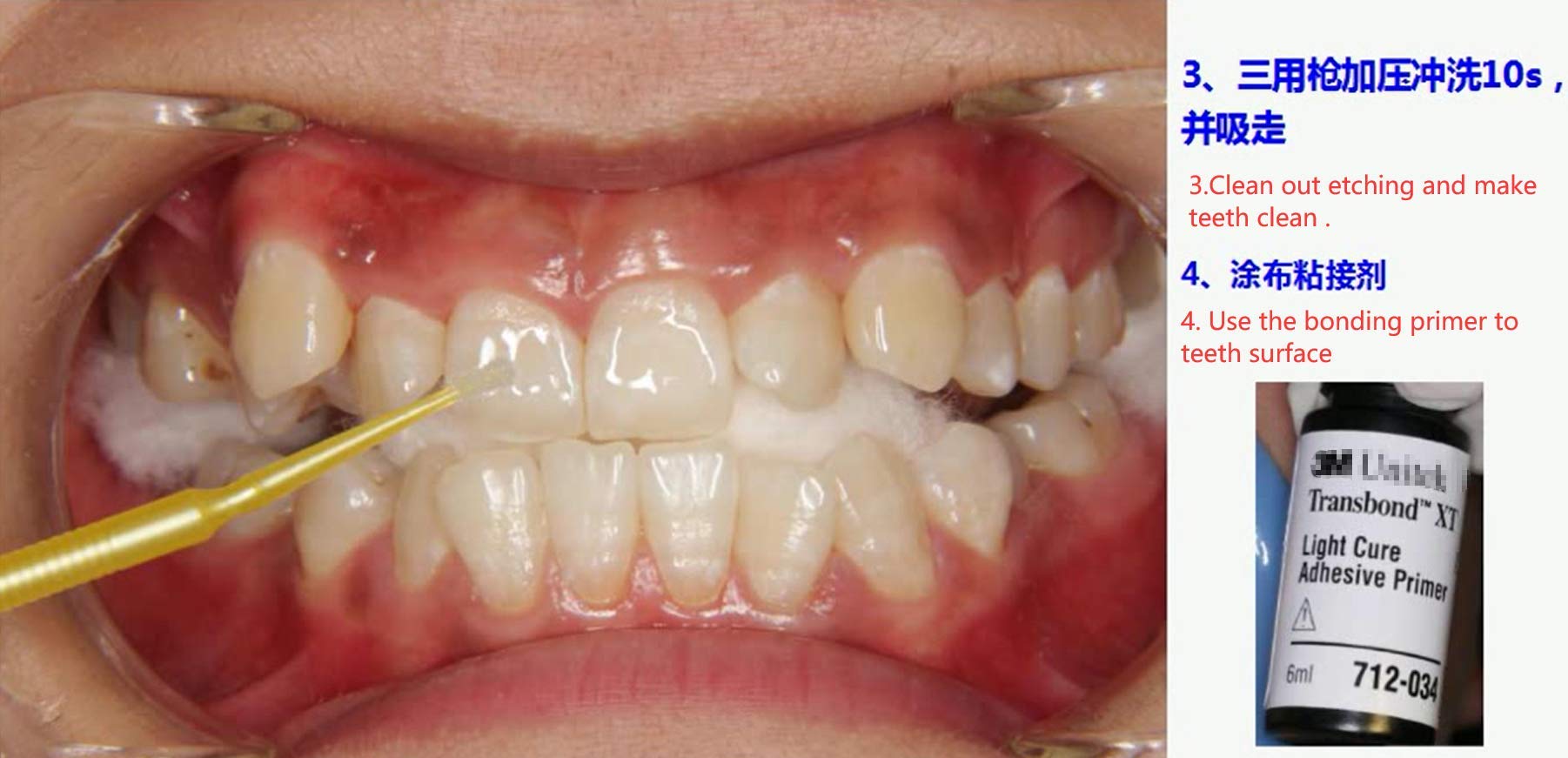 Sino Dental Orthodontic Brackets Glue Braces Bonding Light Cure