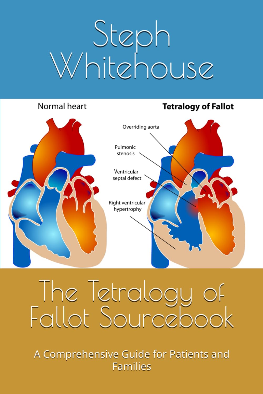 The Tetralogy of Fallot Sourcebook: A Comprehensive Guide for Patients and Families