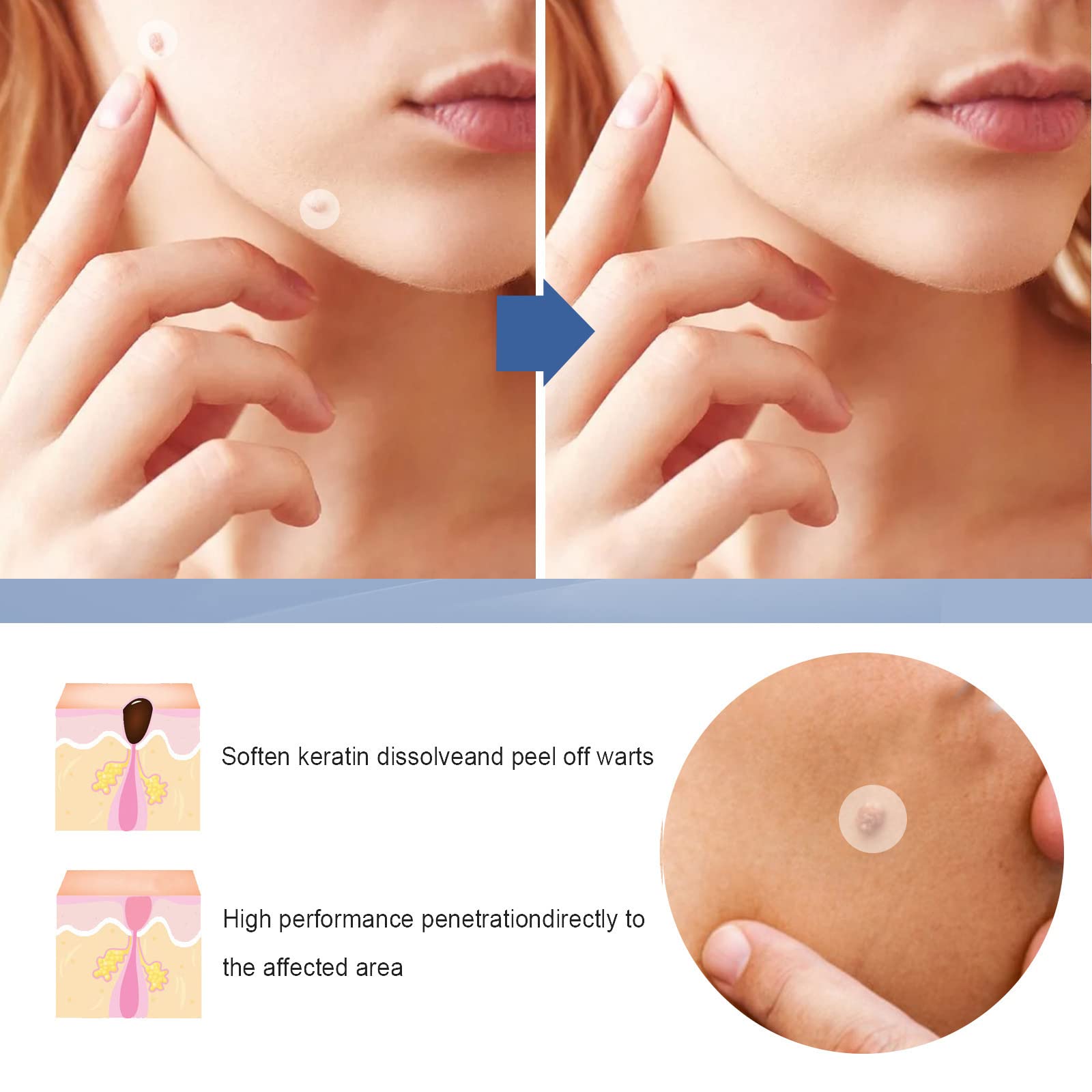 Wart and Mole Removal Patches,Parches Quita Verrugas Cuello y Cara,Producto de Verrugas,Skin Tag Removal Patches,Parches Quita Wart Cuello y Cara,para Mujer Hombre,144 Piezas