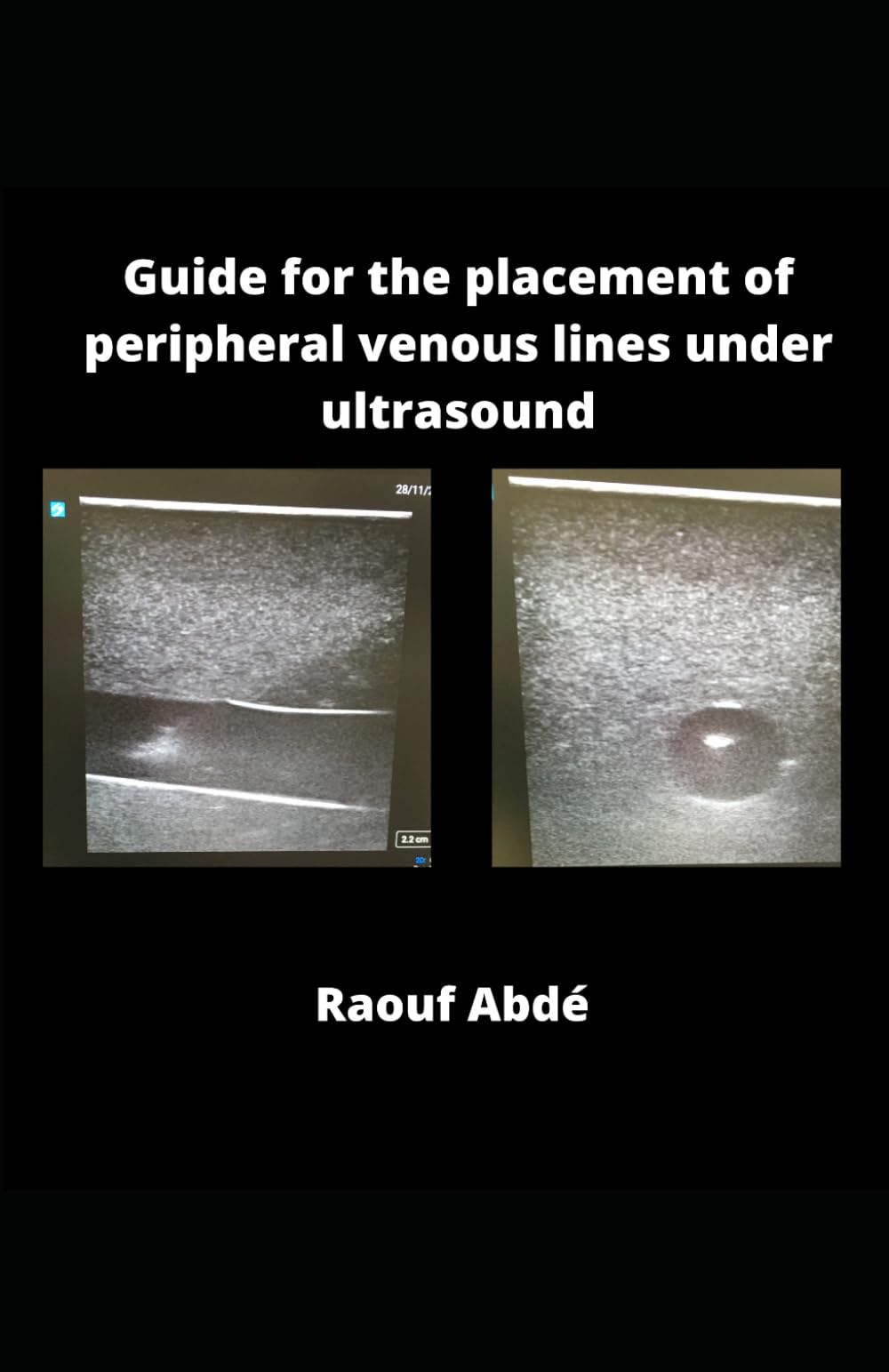 Guide for the placement of peripheral venous lines under ultrasound