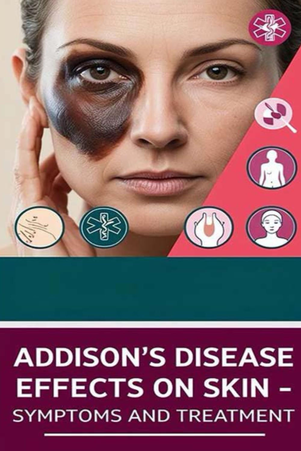 Addison’s Disease Effects on Skin - Symptoms and Treatment: Addison's disease is a rare adrenal gland disease that causes various symptoms, including