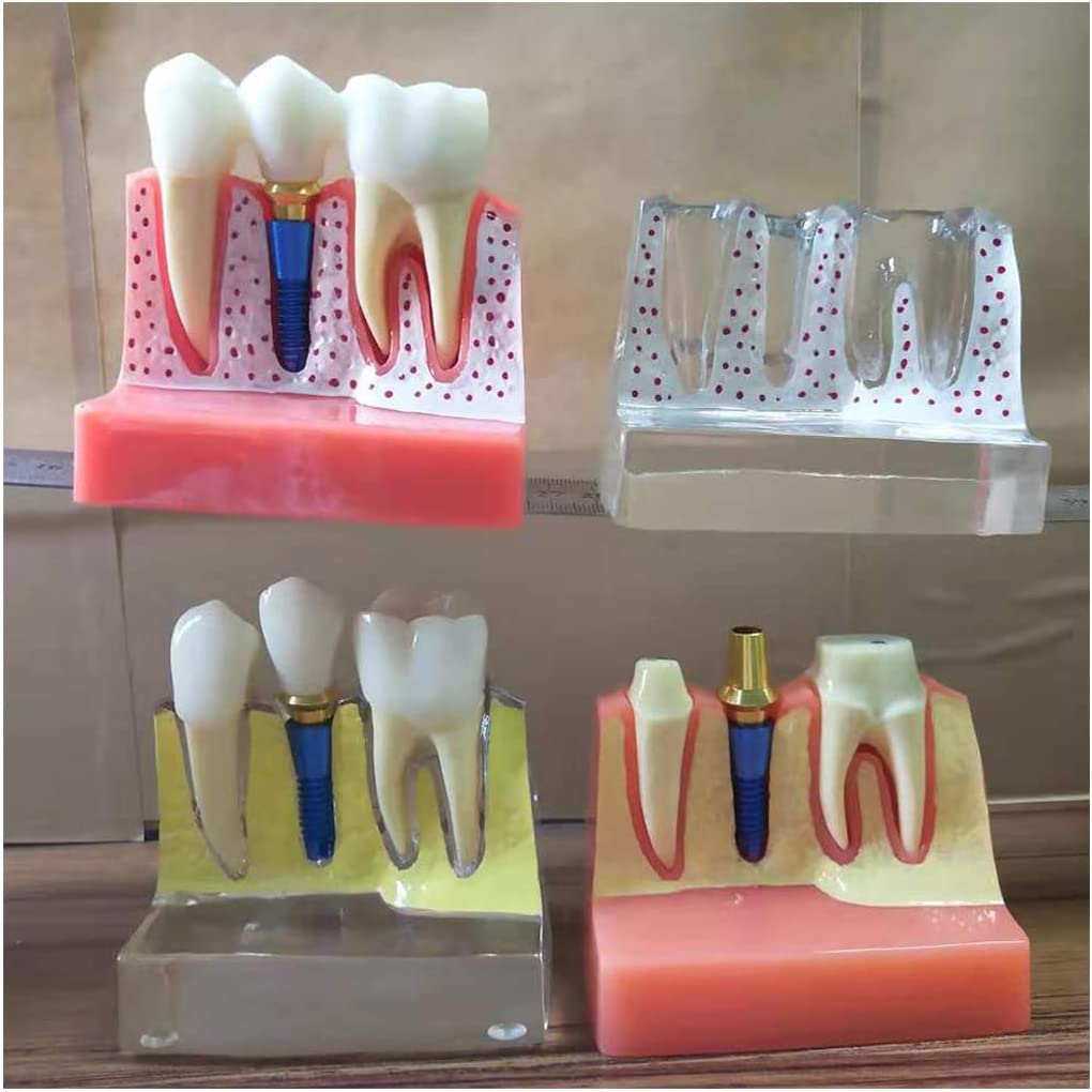 Modèle D'implant Dentaire Modèle D'éducation Dentaire Modèle D'implant Dentaire Degrete Modèle Dentaire sans Dents Modèle D'implant Dentaire Pratique Dental Workforce